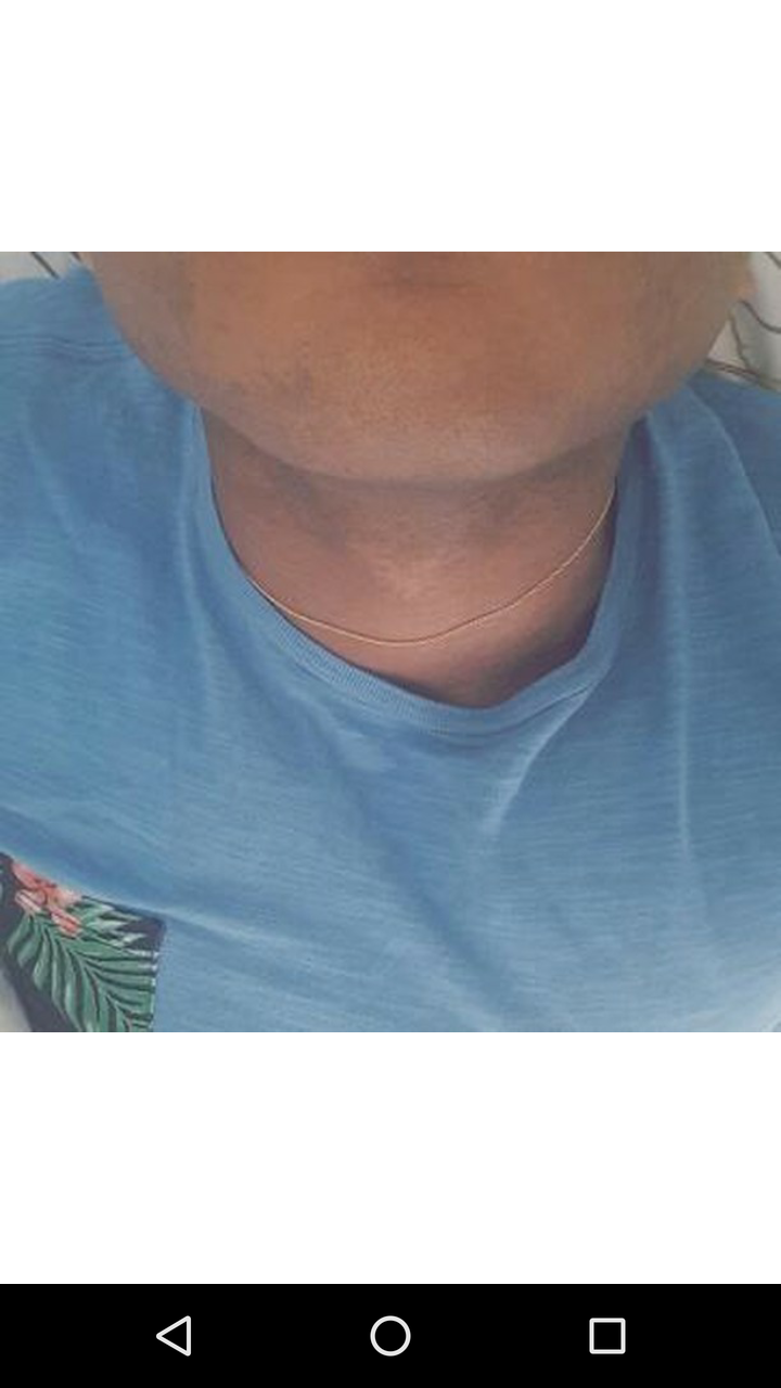 Pescoço após uso do Tend Skin — foliculite tratada e pele recuperada
